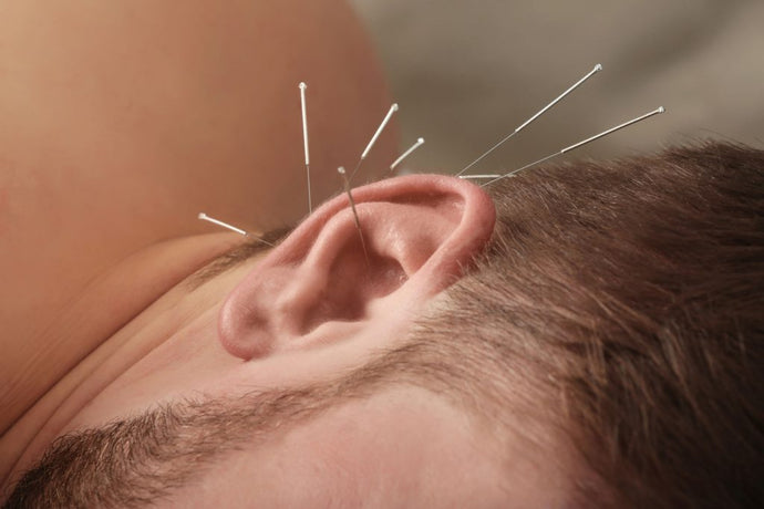 Can Acupuncture Help My Insomnia?
